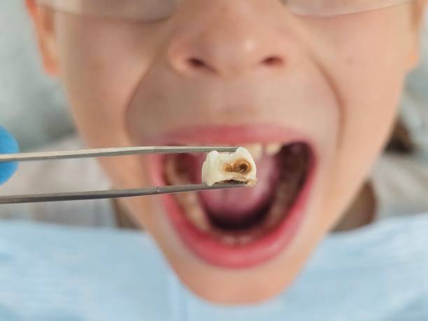 Best Emergency Dental Filling Replacement  in Oak Hills, PA